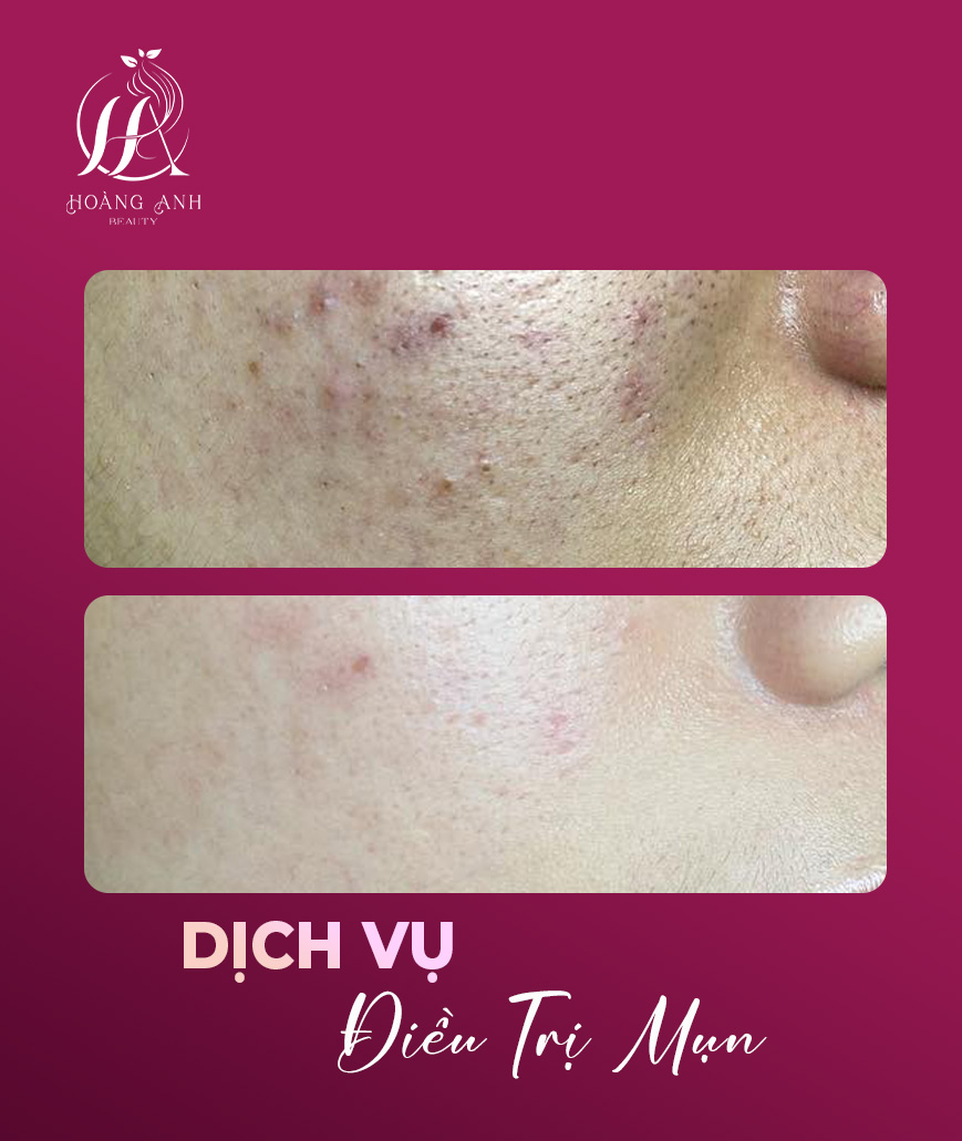 Điều trị da chuyên sâu 3 Điều trị mụn nám, một công việc quan trọng trong tái cấu trúc làn da của bạn